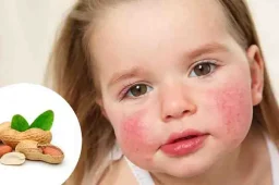 آیا آجیل حساسیت زاست